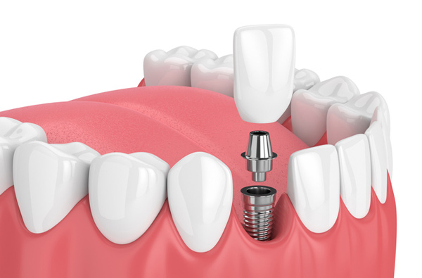 dental-implant-turkey